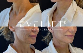 female patient before and after EVELIFT®