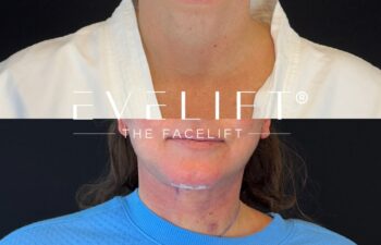 female patient before and after EVELIFT®