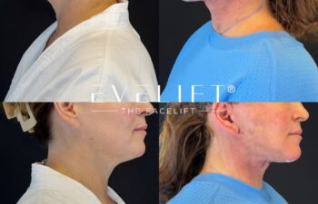 female patient before and after EVELIFT®