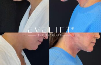 female patient before and after EVELIFT®