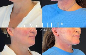 female patient before and after EVELIFT®