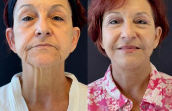 female patient before and after EVELIFT®