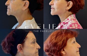 female patient before and after EVELIFT®
