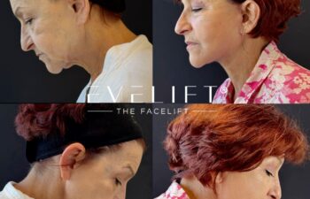 female patient before and after EVELIFT®