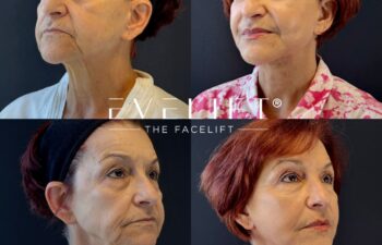 female patient before and after EVELIFT®