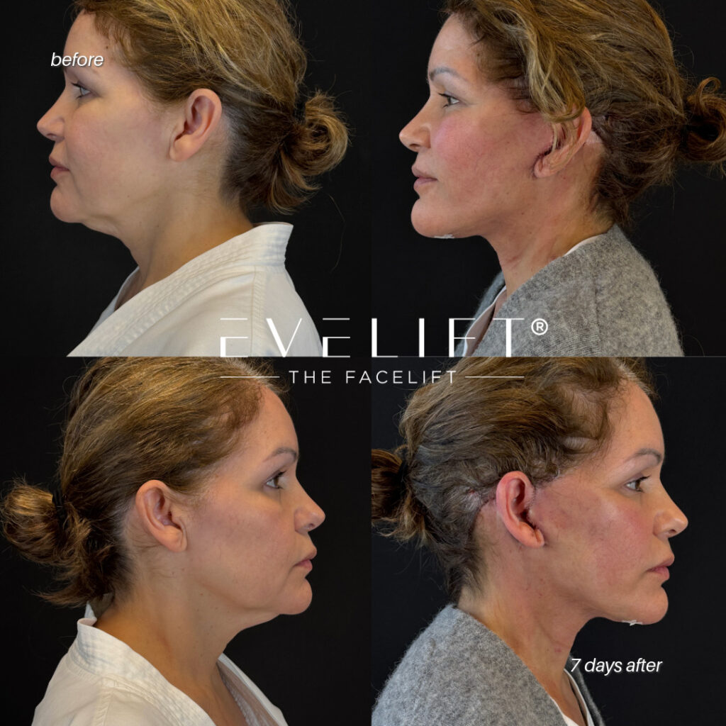 female patient before and after EVELIFT®