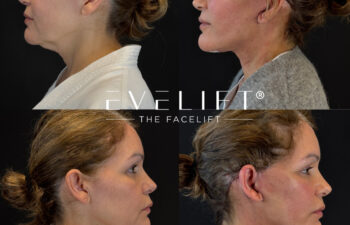 female patient before and after EVELIFT®