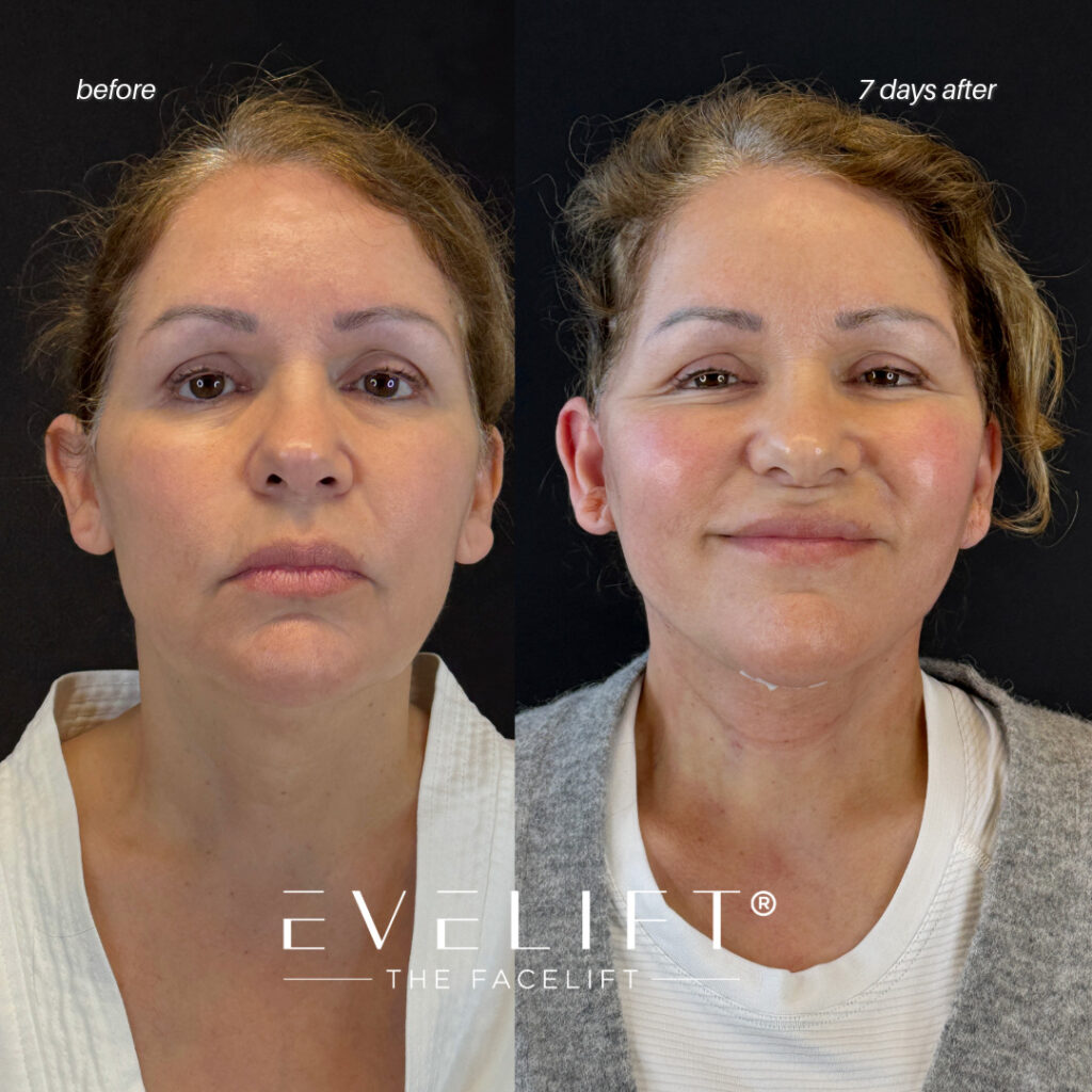 female patient before and after EVELIFT®