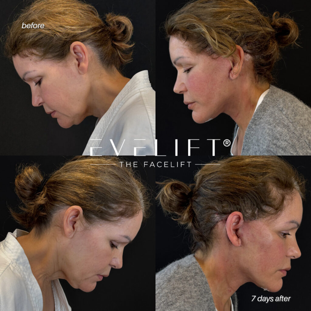 female patient before and after EVELIFT®