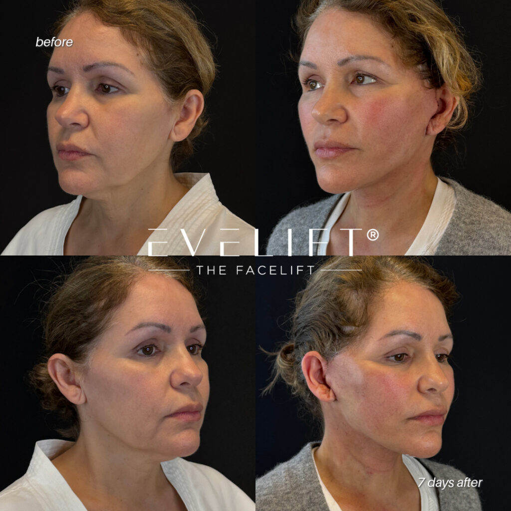 female patient before and after EVELIFT®