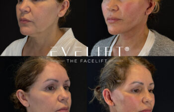 female patient before and after EVELIFT®