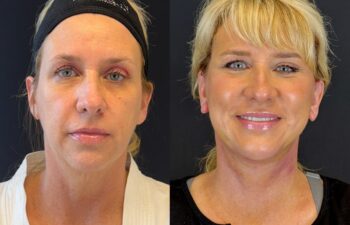 female patient before and after EVELIFT®