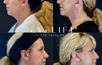 female patient before and after EVELIFT®
