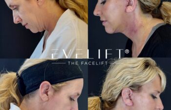 female patient before and after EVELIFT®