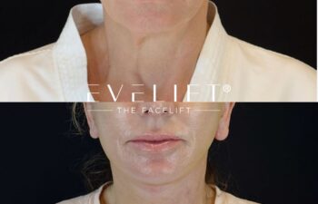 female patient before and after EVELIFT®