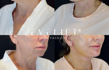 female patient before and after EVELIFT®