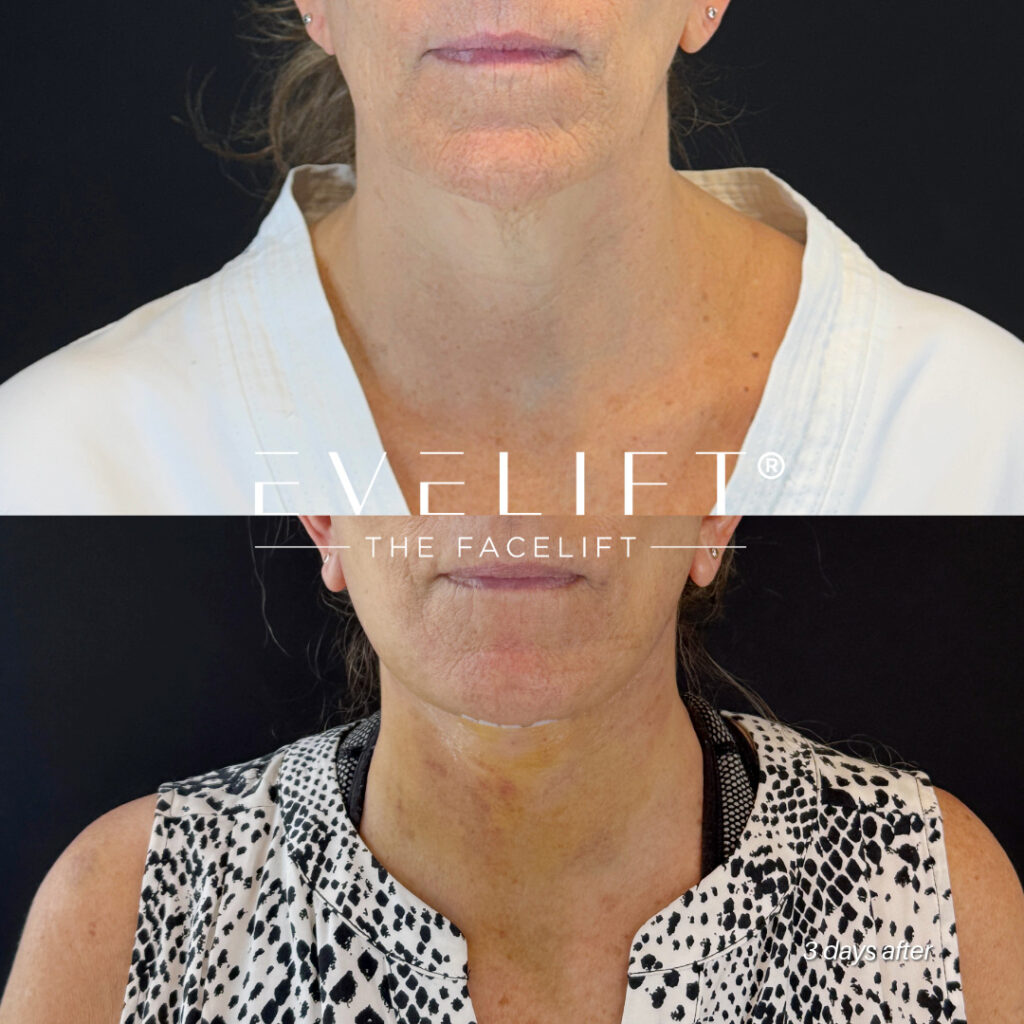 female patient before and after EVELIFT®