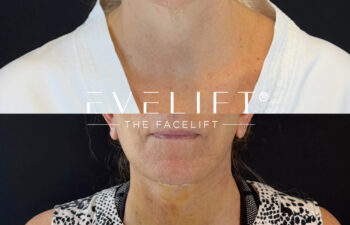 female patient before and after EVELIFT®