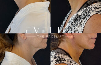 female patient before and after EVELIFT®