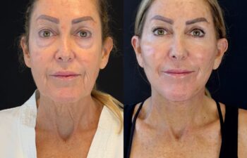 female patient before and after EVELIFT®