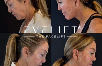 female patient before and after EVELIFT®