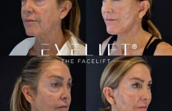 female patient before and after EVELIFT®