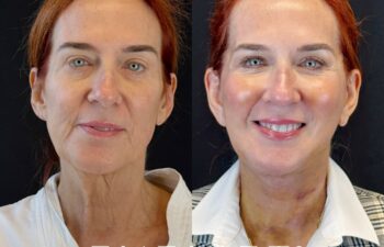 female patient before and after EVELIFT®