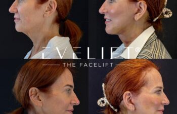 female patient before and after EVELIFT®