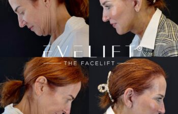 female patient before and after EVELIFT®