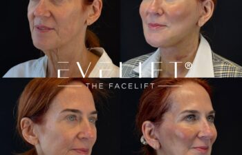 female patient before and after EVELIFT®