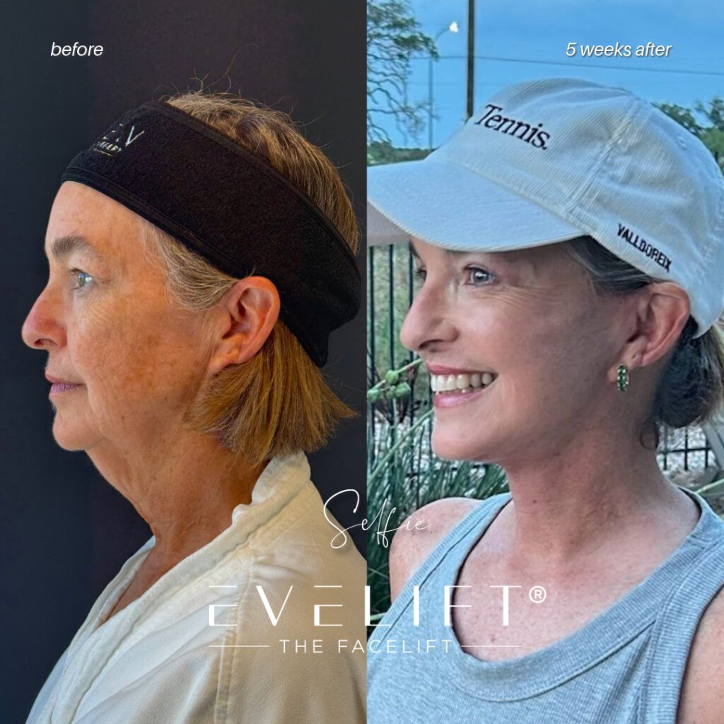 female patient before and after EVELIFT®