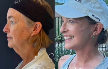 female patient before and after EVELIFT®