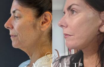 female patient before and after EVELIFT®