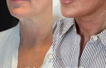 female patient before and after EVELIFT®