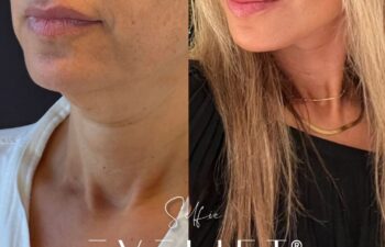 female patient before and after EVELIFT®