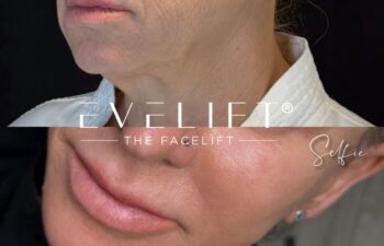 female patient before and after EVELIFT®