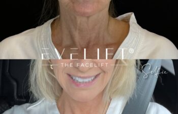 female patient before and after EVELIFT®