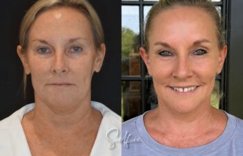 female patient before and after EVELIFT®