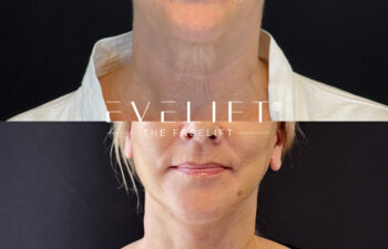 female patient before and after EVELIFT®