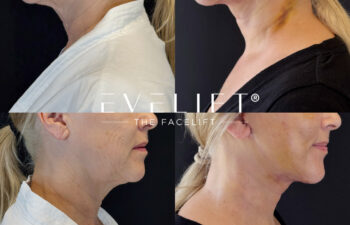 female patient before and after EVELIFT®