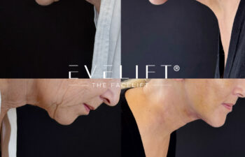 female patient before and after EVELIFT®
