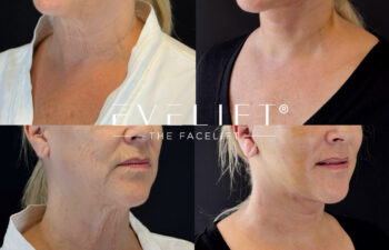 female patient before and after EVELIFT®