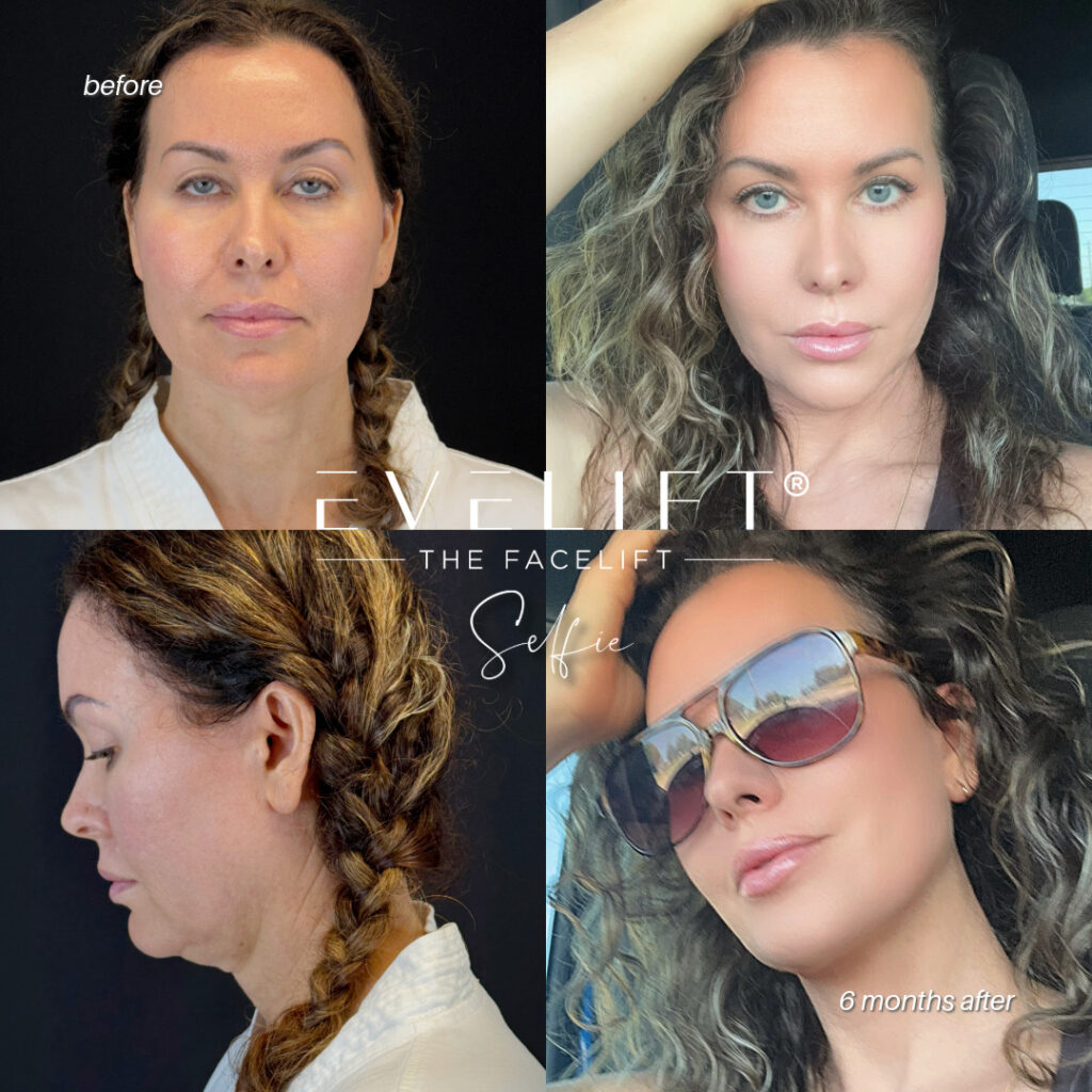 female patient before and after EVELIFT®