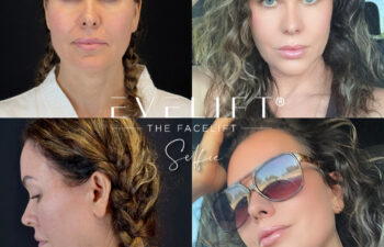 female patient before and after EVELIFT®