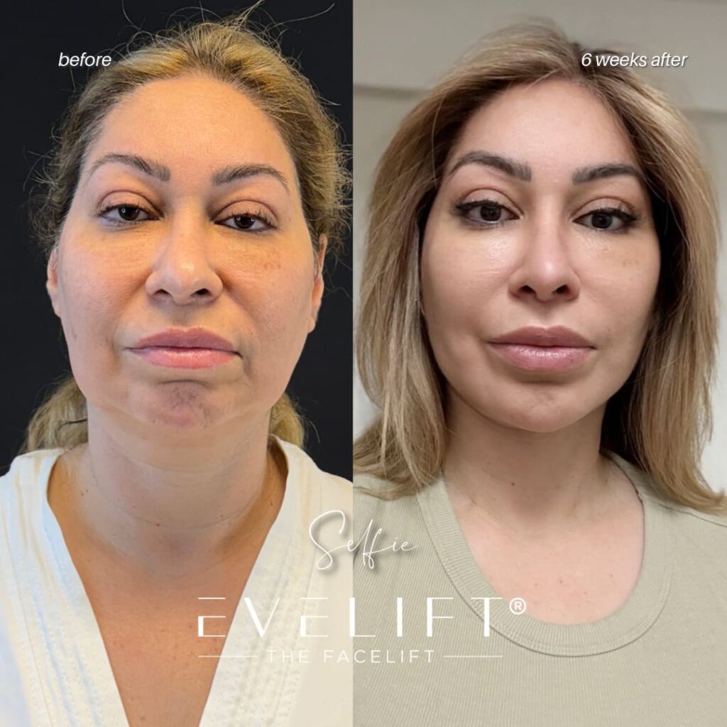 female patient before and after EVELIFT®