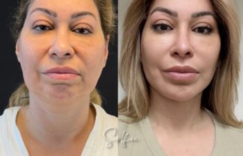 female patient before and after EVELIFT®