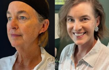 female patient before and after EVELIFT®