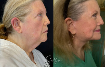 female patient before and after EVELIFT®