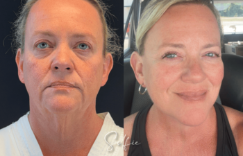 female patient before and after EVELIFT®