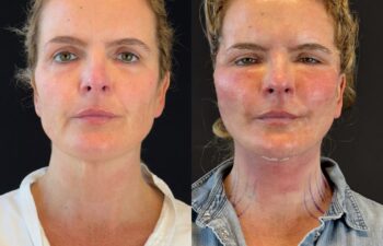 female patient before and after EVELIFT®